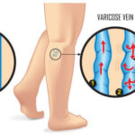 Home remedy for Varicose Veins