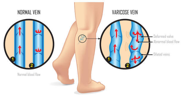 home remedy for varicose veins